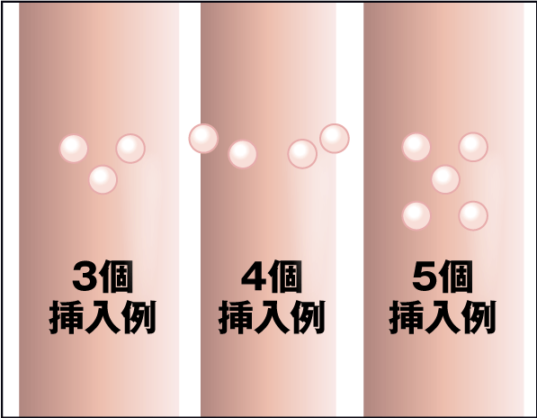 医師が解説 シリコン劣化 Msクリニック新宿 横浜 名古屋 大阪