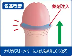 包茎改善効果