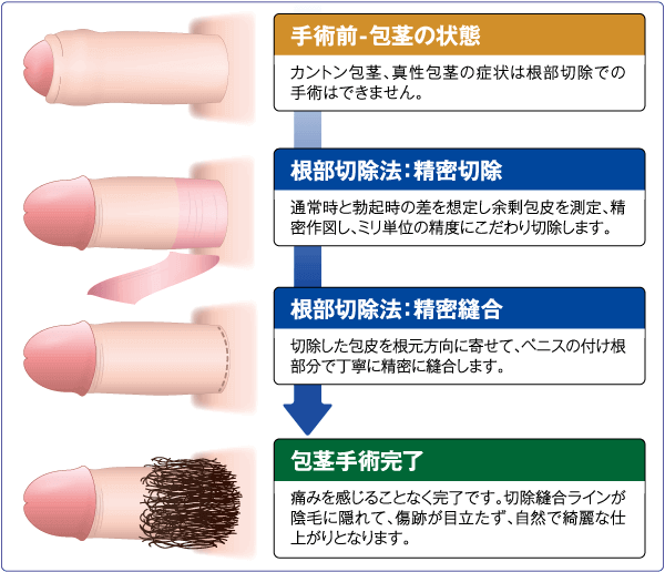 仮性 方形 直し 方 自力