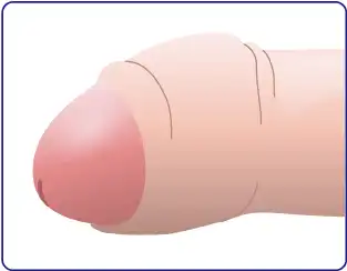 仮性包茎の症状