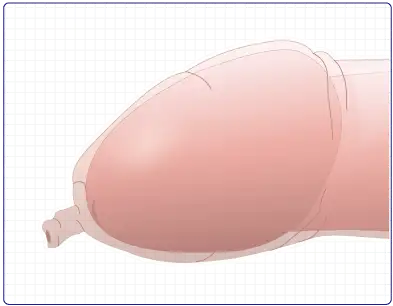 真性包茎の症状とタイプ
