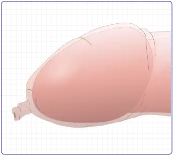 真性包茎