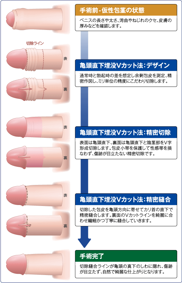 仮性 方形 直し 方