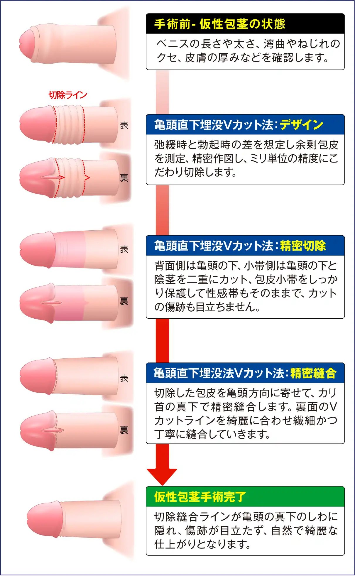 亀頭直下埋没WVカット法