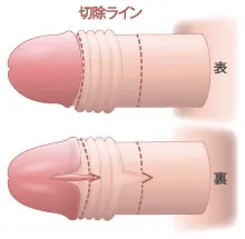 亀頭直下埋没Vカット法：デザイン