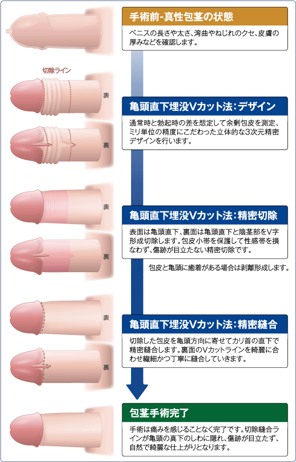 真性包茎について｜MSクリニック