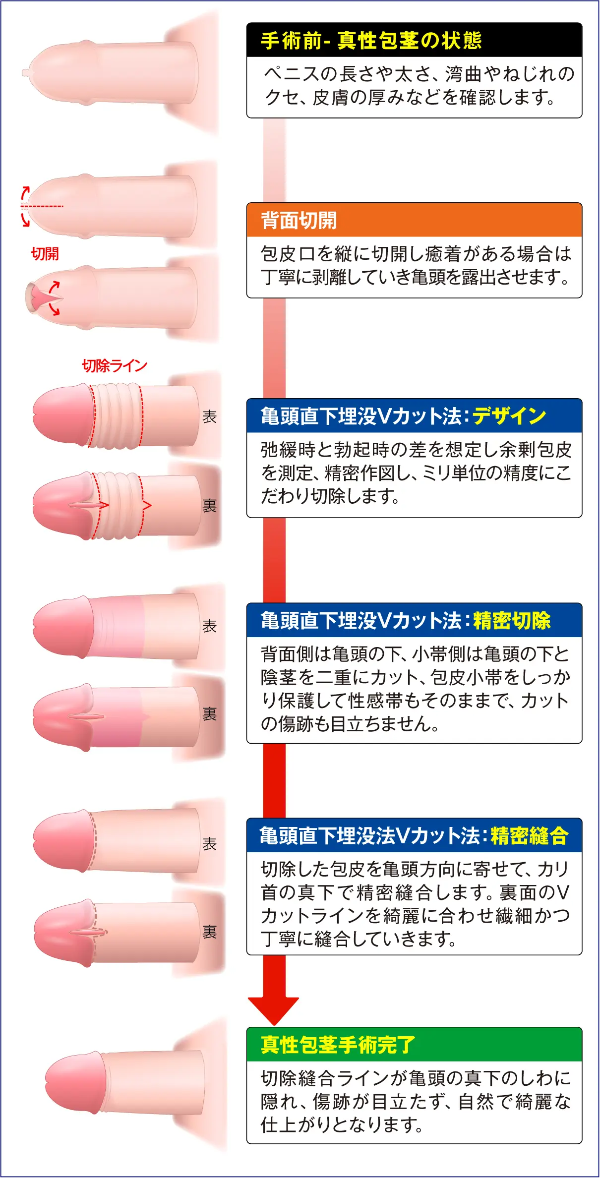 真性包茎手術：亀頭直下埋没Vカット法の手術手順