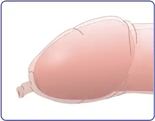 真性包茎の症状