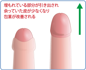 長茎術 切らない長茎術 Msクリニック 長茎術 切らない長茎術 Msクリニック