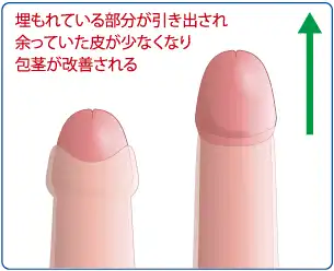 包茎改善
