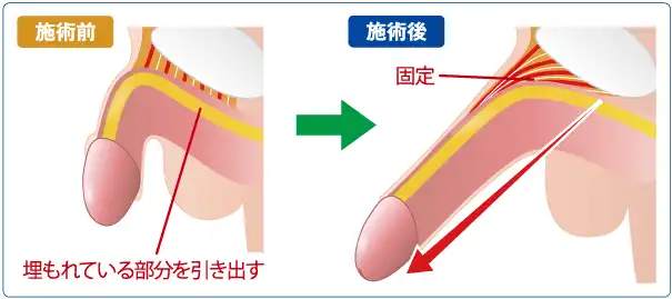 切らない長茎術とは