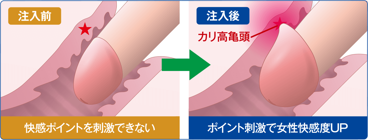 ペニス増大 亀頭増大術 メンズサポートクリニック新宿院 横浜院