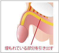 長茎術 切らない長茎術 Msクリニック