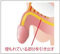 施術前の切らない長茎術の説明イラスト画像