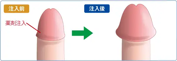 薬剤注入による亀頭増大術
