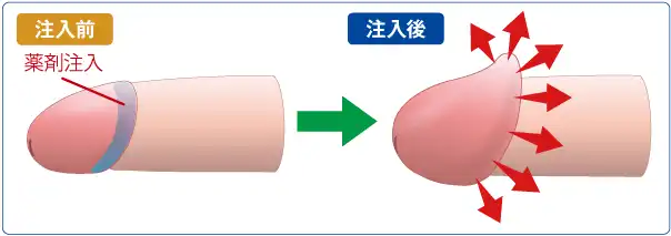 カリ高注入法