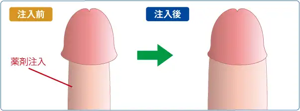 ペニス増大手術