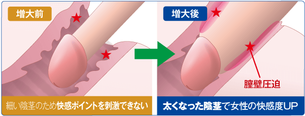 ペニス増大 陰茎増大 Msクリニック