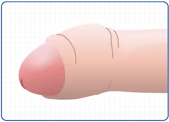 包茎性早漏