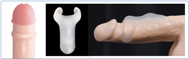 シリコンボール シリコンリング シリコンバー Msクリニック