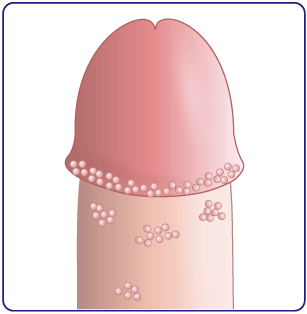 陰茎 痒み