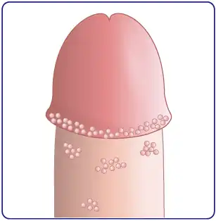 尖圭コンジローマ