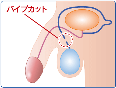 パイプ カット 性欲