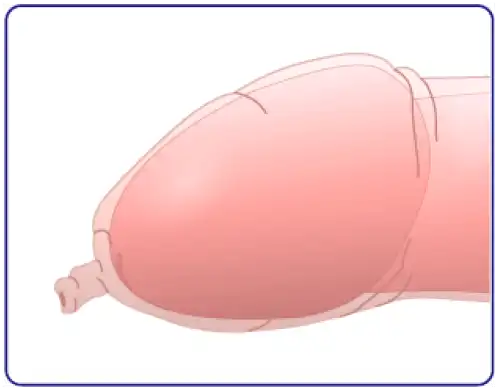 真性包茎の症状