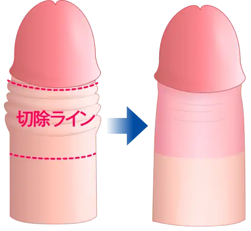 余剰包皮を切除