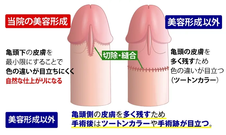 包茎手術後の比較《ウラ側》