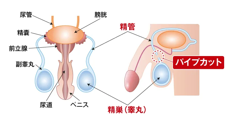 パイプカット手術精管切除結紮法（せいかんせつじょけっさつほう）のイメージ