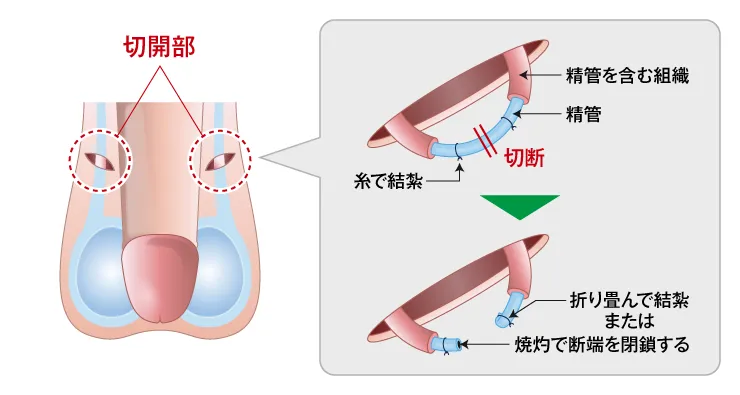 パイプカット手術の図
