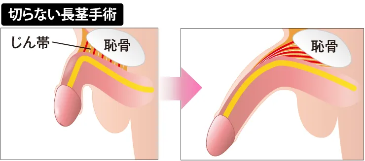 切らない長茎術の図解