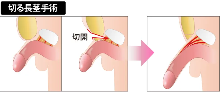 切る長茎術の図解