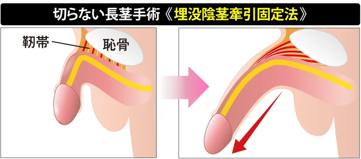 切らない長茎術の図解