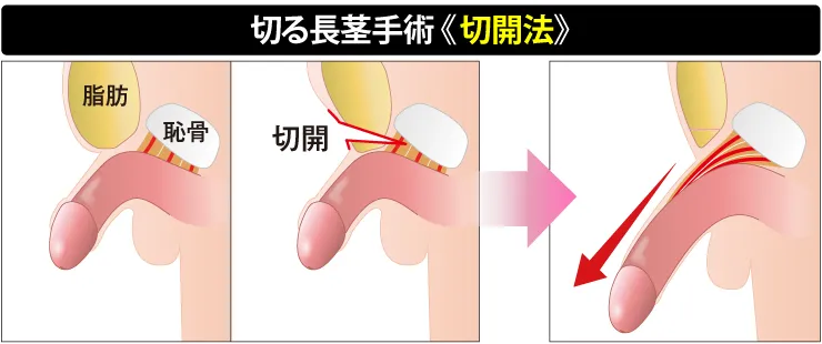 切る長茎術の図解
