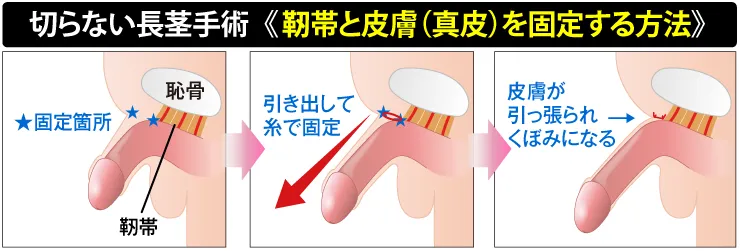 切らない長茎術の図解
