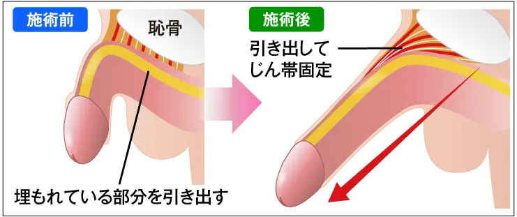切る長茎術の図解
