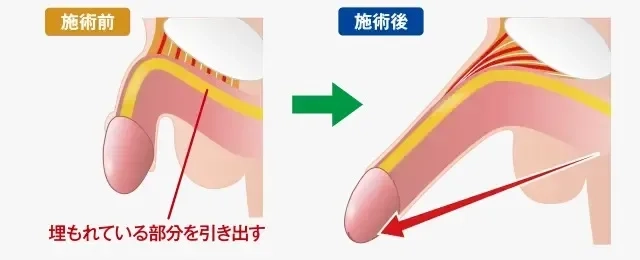 切らない長茎術で2〜8cm長く