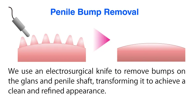 Penile Bump Removal photo