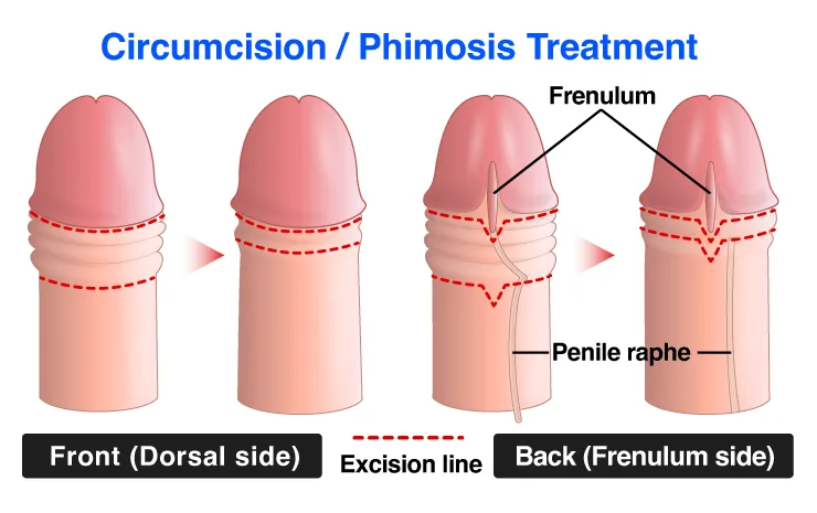 Circumcision / Phimosis Treatment photo