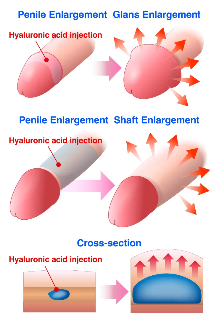Penile Enlargement / Glans Enlargement / Shaft Enlargement photo