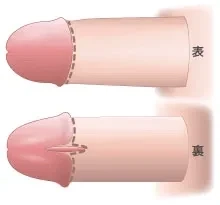 亀頭直下埋没Vカット法：精密切除