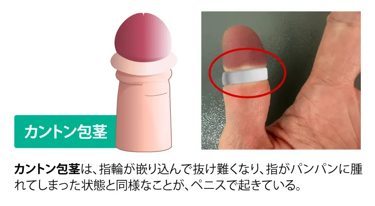 嵌頓(かんとん)包茎のイラストとイメージ画像