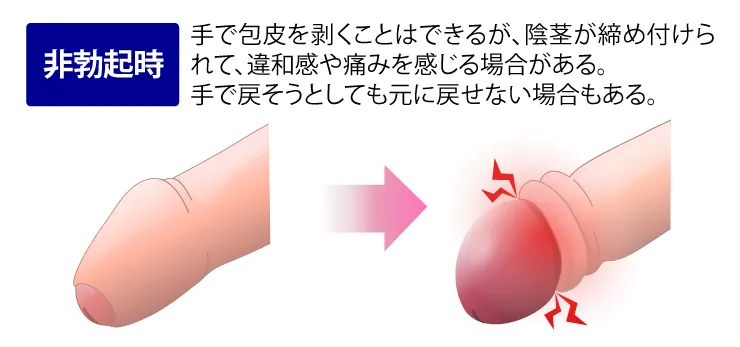 非勃起時で嵌頓(かんとん)カントン包茎の確認のイラスト