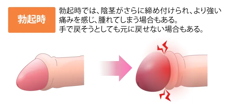 勃起時で嵌頓(かんとん)カントン包茎の確認のイラスト