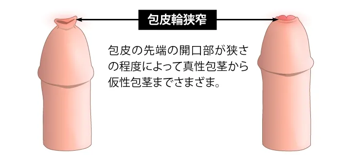 包皮輪狭窄のイラスト
