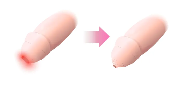 後天性の真性包茎