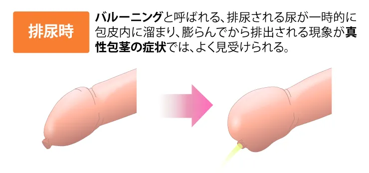 真性包茎のバルーニングのイメージイラスト