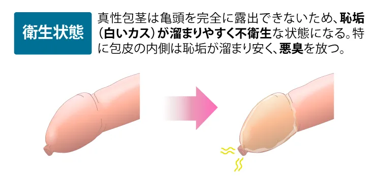 真性包茎の不衛生のイメージイラスト